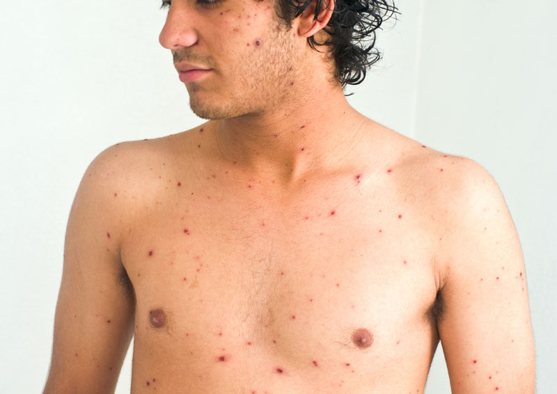 immigration measles